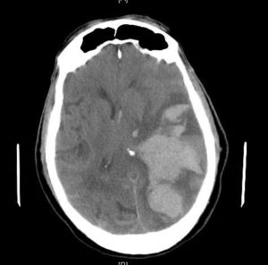 Subfalcine herniation