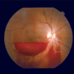Subhyaloid macular hemorrhage