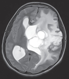 Supratentorial clear cell meningioma in a child