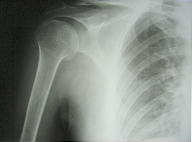 Surgical neck fracture of humerus