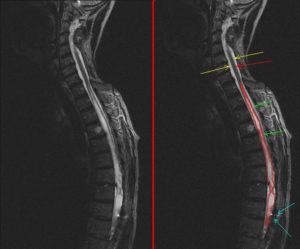 Syringomyelia