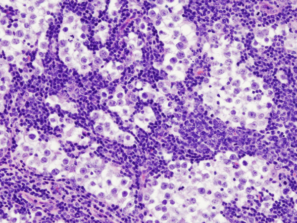 Testicular seminoma nodal metastasis