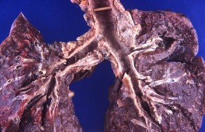 The mucosa of the trachea and bronchi is ulcerated and granular. The mucosa of the trachea and bronchi is ulcerated and granular.
