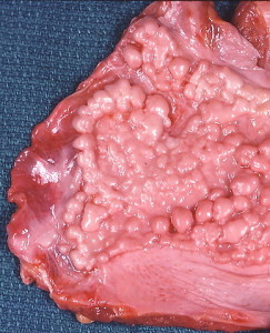 This fibrous plaque on the diaphragmatic pleura has a verrucous appearance