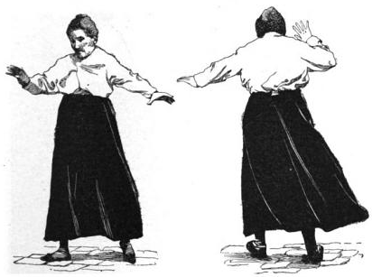 illustration of the altered walking gait of a woman with cerebellar disease