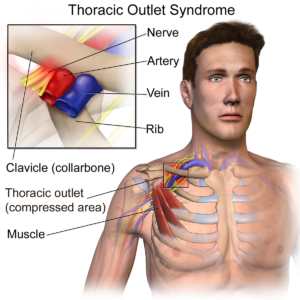 Thoracic outlet syndrome
