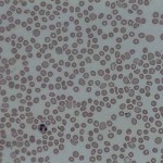 Thrombocytopenia blood film Thrombocytopenia blood film