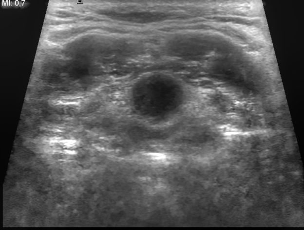 thyroglossal duct cyst ultrasound image
