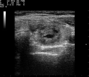 Thyroid_ultrasound