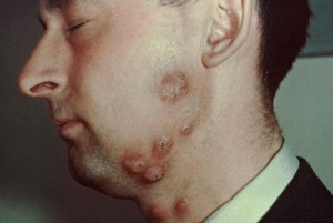 Tinea barbae on a white male patient
