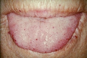 Tongue telangiectases in hereditary hemorrhagic telangiectasia Tongue telangiectases in hereditary hemorrhagic telangiectasia