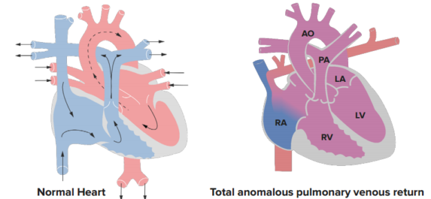 Total Anomalous Pulmonary Venous Connection