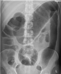 Toxic megacolon in ulcerative colitis