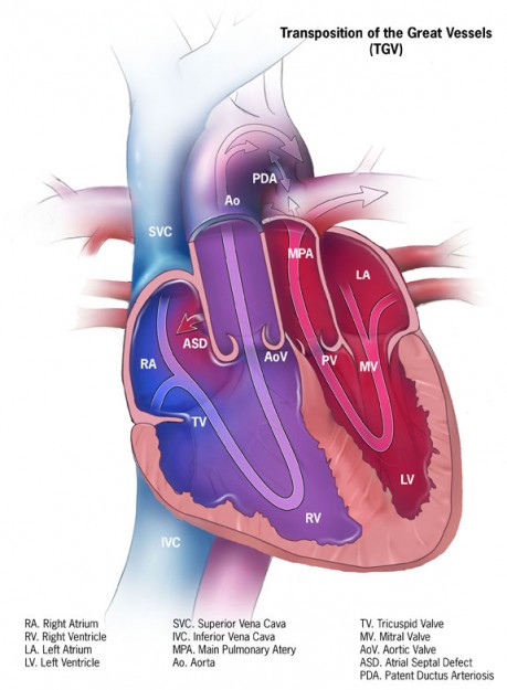 Transposition of the Great Arteries (TGA) Transposition of the Great Arteries (TGA)