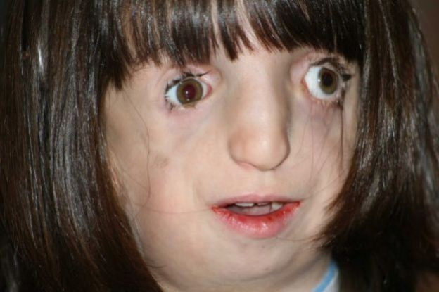 Treacher-Collins Syndrome (TCS) and Pierre Robin Sequence