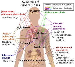 Tuberculosis symptoms