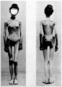 Two images of an anorexic female patient in a French medical journal Nouvelle Iconographie de la Salpêtrière vol 13, published in 1900.