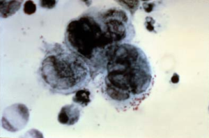 Tzanck test herpes