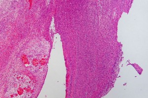 Ulcerating and necrotizing appendicitis with perforation Ulcerating and necrotizing appendicitis with perforation