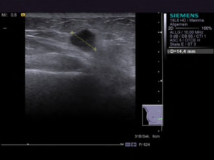 Ultrasonography breast cancer