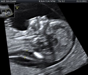 Ultrasound image of measurements of fetal nuchal translucency, and absent nasal bone at 11 weeks of pregnancy. CVS demontrated a trisomy 21 of the fetus