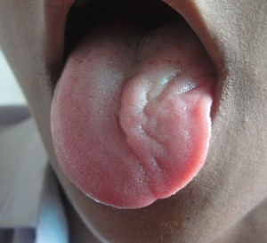 Unilateral hypoglossal nerve injury