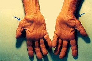"Untreated Carpal Tunnel Syndrome" by Dr. Harry Gouvas. License: Public Domain.