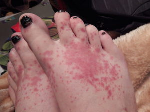 Urticaria on the feet