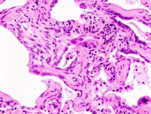Usual interstitial pneumonia Usual interstitial pneumonia