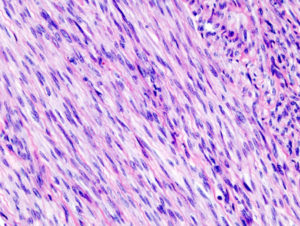 histopathology of uterine leiomyoma