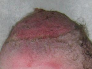 Vacuum Extraction bruised scalp