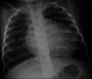 Ventricular Septal Defect (VSD)