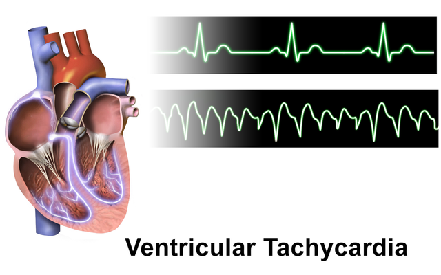 Ventricular Tachycardia