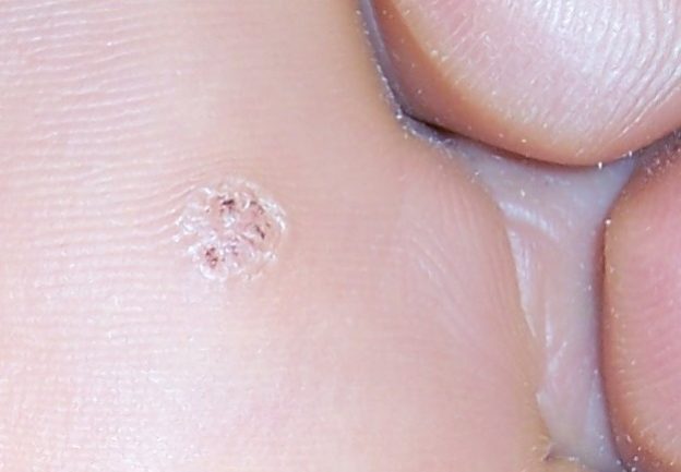 foot wart with black dots)