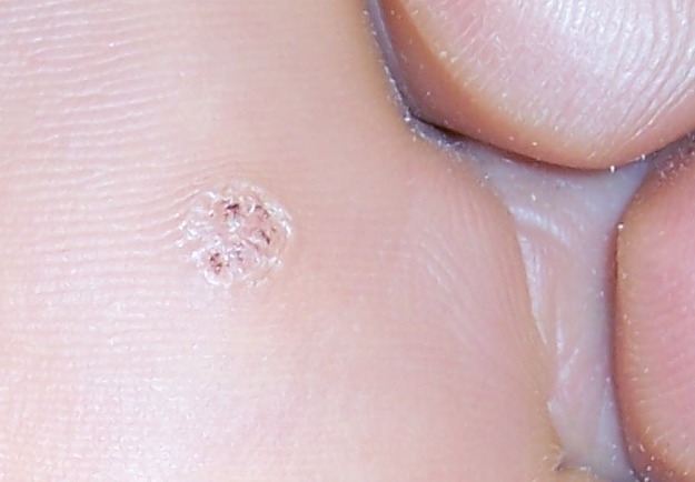 wart on the foot)