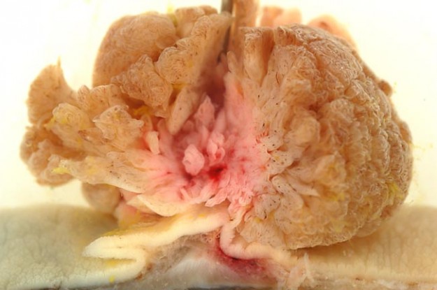 Villous adenoma of the sigmoid colon