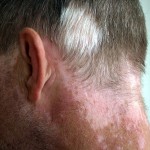 Vitiligo-affecting-hair-and-neck