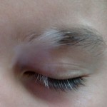 Vitiligo-and-poliosis