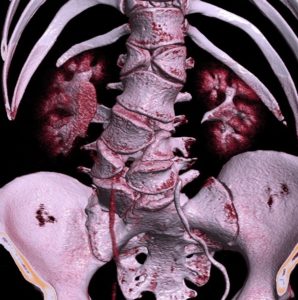 CT_of_butterfly_vertebrae - alagille syndrome