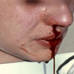 Von Willebrand Disease Von Willebrand Disease