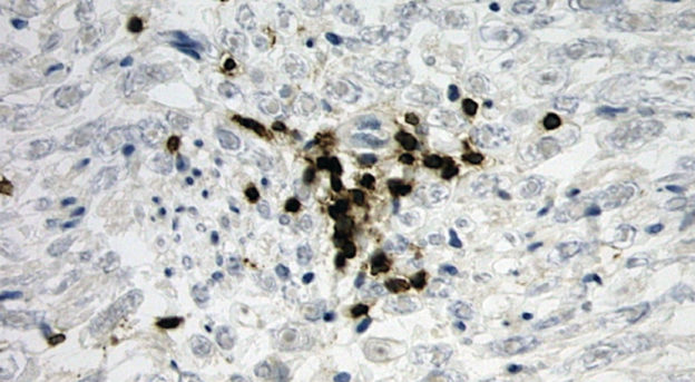T-lymphocytes within myocardium