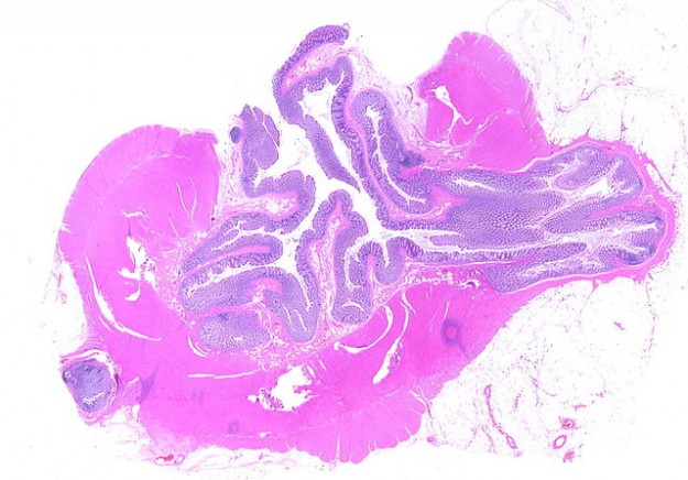 Whole slide of a transverse section of left colon with diverticulosis Whole slide of a transverse section of left colon with diverticulosis