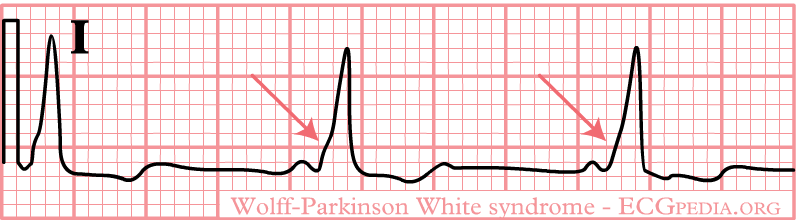 wolf parkinsons white syndrome