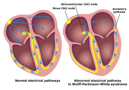 Wolff-Parkinson-White (WPW) Syndrome — Causes, ECG and Treatment