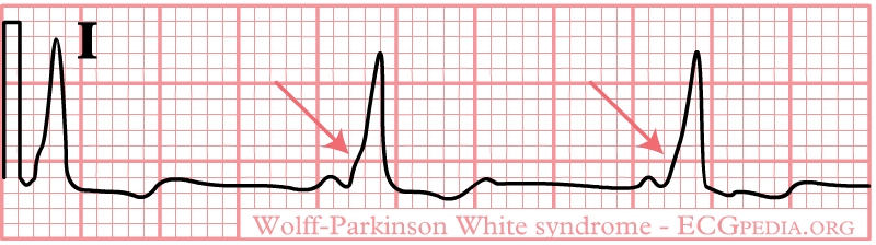 Wolff-Parkinson-White (WPW) Syndrome — Causes, ECG and Treatment