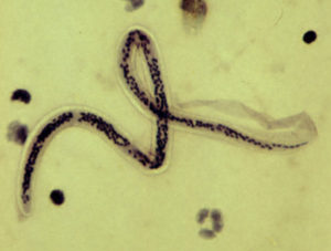 wuchereria bancrofti