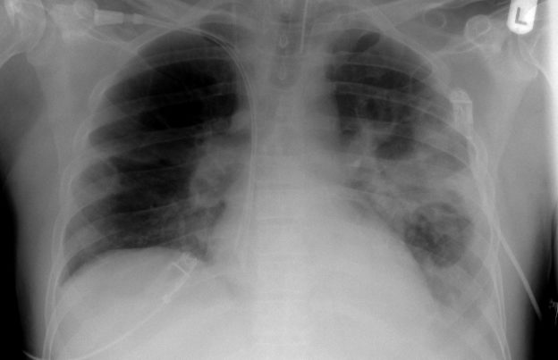 chest x-ray pneumonia with abscess and caverns