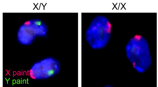 Xy Gonadal Dysgenesis Swyer Syndrome — Signs And Symptoms