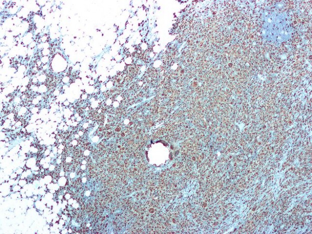 Xanthogranulomatous pyelonephritis Xanthogranulomatous pyelonephritis