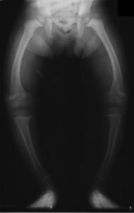 legs x-ray rickets